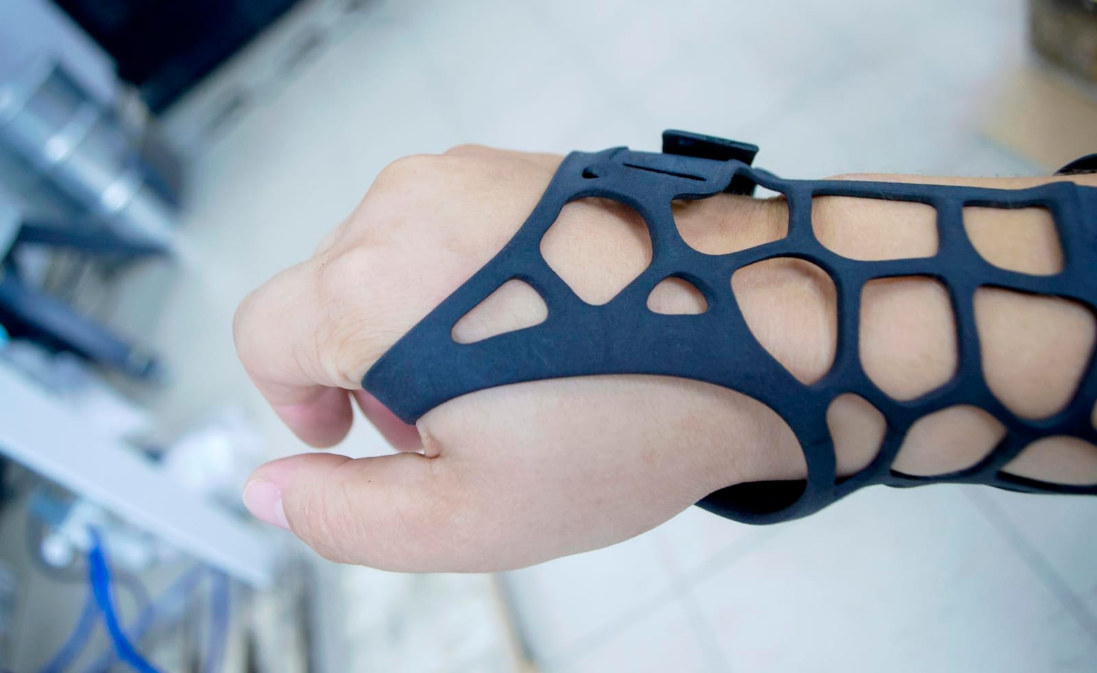 Aparelho ortopédico impresso em 3D encaixado na mão de uma pessoa